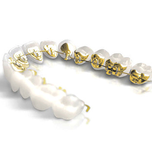 festsitzende Zahnspangen auf der Zahninnenseite