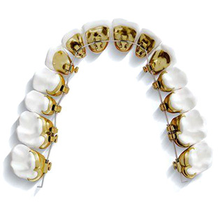 Festsitzende Zahnspangn auf der Zahninnenseite