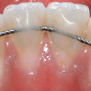 Stabilisierung der Zähne nach Zahnkorrektur