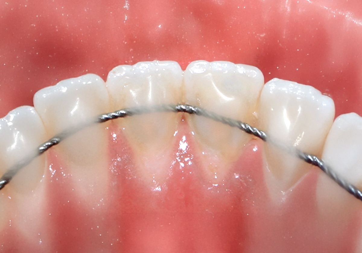 Retainer